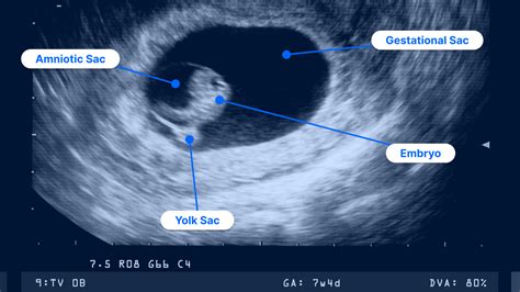 what is cas ultrasound|Instructions for Your First Pregnancy Ultrasound .